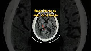 Acute Infarct Brain Radiology [upl. by Brenna381]