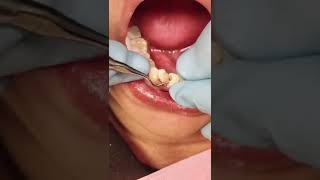 Cementing Dental Bridge on Lower Anteriors  In Office to Hands On Dental Training [upl. by Joktan]