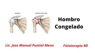 Los mejores Estiramientos y Ejercicios para el Hombro Congelado  FisioterapiaRD [upl. by Dlnaod472]