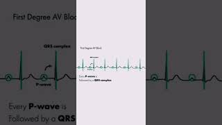 First degree AV block vs 2nd degree Av Block education Heart blocks types ecg drirfan ekg [upl. by Rosalia]