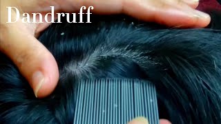 ASMR Real Person Dandruff Flakes Removal  Tingly Satisfying 🥱😴💤 [upl. by Ephram]