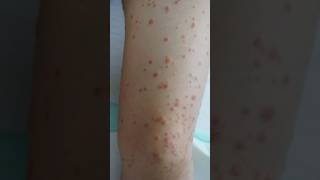 Guttate psoriasis  psoriasis skin psoriasisawareness psoriasissolution dermestidscanada short [upl. by Reginauld937]