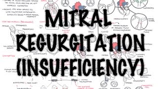 Mitral Reguritation insufficiency  Overview signs and symptoms pathophysiology treatment [upl. by Htiekal]