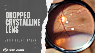 Dropped Crystalline Lens Posteriorly Dislocated After Blunt Trauma [upl. by Aekan237]