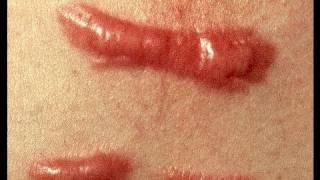 DermTV  How to Treat a Keloid Scar DermTVcom Epi 279 [upl. by Onairda]