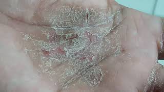 Palmar Keratoderma Shocked to read its incurable [upl. by Barbi]