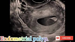 Endometrial polyp in ultrasound views [upl. by Abbey]