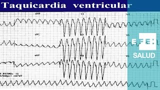 Taquicardia Ventrículos a 200 mortíferos latidos [upl. by Deming]