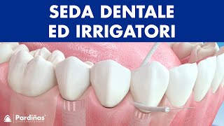 Seda dentale ed Irrigatori – Metodi di pulizia degli impianti © [upl. by Bethesda]