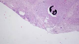 Actinomycosis in Liver with GMSHaematoxylin and Eosin Staining [upl. by Ahsercul]