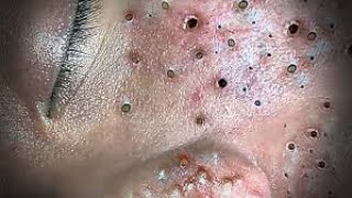 Toltal Best blackheads by Loan Nguyen No ads [upl. by Desai]