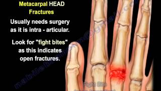 Metacarpal Fractures  Everything You Need To Know  Dr Nabil Ebraheim [upl. by Quartet]