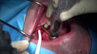 Immediate implant placement in mandibular molar extraction socket [upl. by Adanar]