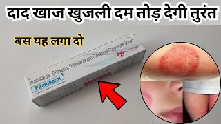 दाद खाज खुजली दम तोड़ देगी तुरंत बस यह लगा दो  Paamderm Plus Cream To Treat Fungal Infection [upl. by Etnuaed]