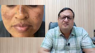 Pigmentation Treatment Price  Laser Pigmentation Treatment  Causes  Kayakalp Laser Clinic [upl. by Jeggar363]