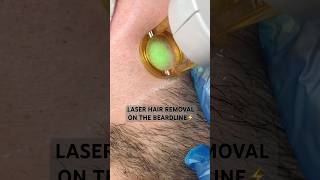 Laser hair removal on the beardline ⚡️ [upl. by Tsenre]