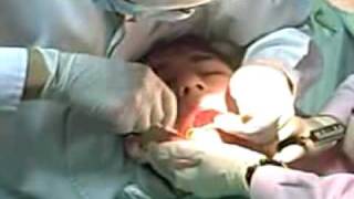 Dentistry Horrors Wisdom tooth procedure full [upl. by Tal]