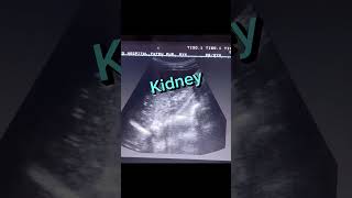 Echogenic Kidney shorts youtube viral [upl. by Raybin271]