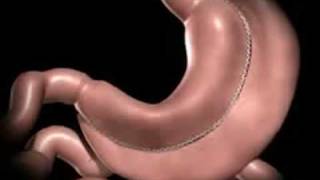 Laparoscopic Vertical Sleeve Gastrectomy by Marc Zare MD [upl. by Nefen]