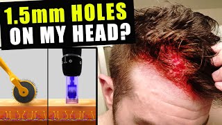 I Cut Thousands Of 15 Millimetre Holes In My Head Every Week To Prevent Hair Loss [upl. by Medeah125]