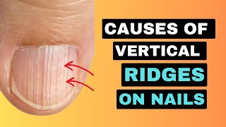 The REAL Causes of VERTICAL RIDGES On Your Nails [upl. by Ashlee777]