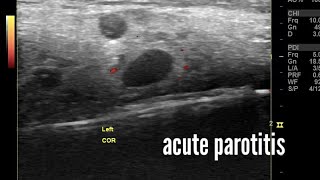 Acute parotitis ultrasound and color Doppler imaging video [upl. by Refinnaj]