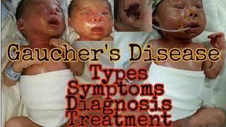 Gaucher Disease  Types symptoms diagnosis treatment  MisMedicine [upl. by Dur]