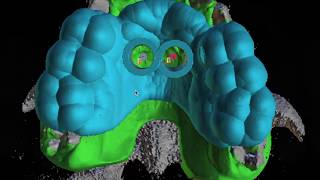 POSITIONING OF PALATAL MINIIMPLANTS FOR A MAXILLARY DISTALIZATION APPLIANCE IN ONE APPOINTMENT [upl. by Nissa830]