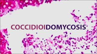 Coccidioidomycosis Valley Fever  Pediatric Grand Grounds  Mattel Childrens Hospital UCLA [upl. by Rosaleen419]