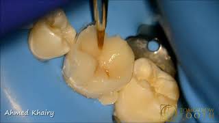 Direct cuspal coverage overlay after endodontic treatment [upl. by Ahseer]