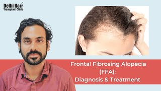 Frontal Fibrosing Alopecia FFA Diagnosis amp Treatment  DHTC  Dr Mukesh Manjhi [upl. by Sievert]