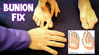 How to Fix a Tailors Bunion Bunionette [upl. by Yseult]