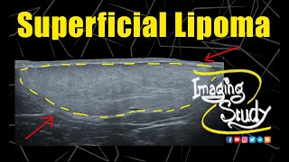 Superficial Lipoma  Ultrasound  Case 325 [upl. by Liag]