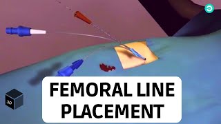 Central Line placement Femoral Vein Medical animation [upl. by Kennard146]