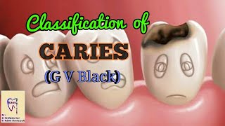 Dental Caries  Classification of dental caries  GV Black Classification [upl. by Haddad974]