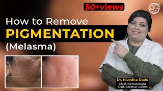 How To Cure Melasma  Latest Treatment For Melasma  Dr Nivedita Dadu [upl. by Tertias88]