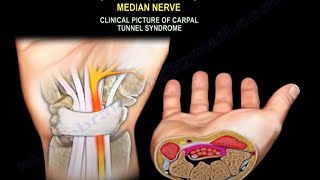 Carpal Tunnel Syndrome  Everything You Need To Know Dr Nabil Ebraheim [upl. by Waterer498]