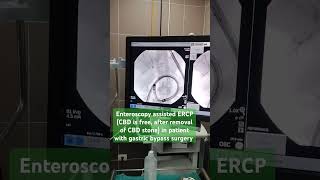 Enteroscopy assisted ERCPCBD is freeafter removal of CBD stonepatient with gastric bypass surgery [upl. by Larimer615]