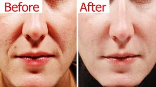 How To Get Rid Of Laugh Lines Naturally  Remove Wrinkles Around the Mouth [upl. by Eita]