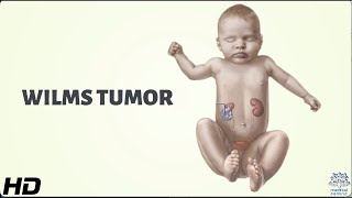 Wilms Tumor Everything You Need To Know [upl. by Latreece987]