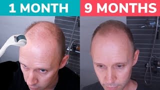 STOP BALDING  Regrow Hair Naturally with Dermaroller Real 9 Month Results [upl. by Rednael624]