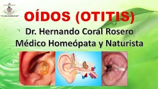 OÍDOS OTITIS  INFLAMACIÓN CON DOLOR FIEBRE Y TRASTORNOS DE LA AUDICIÓN [upl. by Aicelef982]