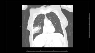 Chest X ray discover pneumonia and lung cancer [upl. by Giacamo757]