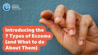 Introducing the 7 Types of Eczema and What to do About Them [upl. by Teemus455]