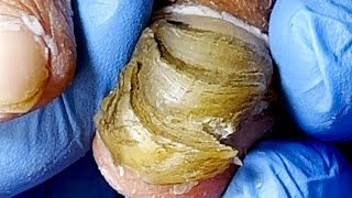 For thick and layered onychomycosis start trimming 【Podiatry Clinic】 [upl. by Ocsic488]