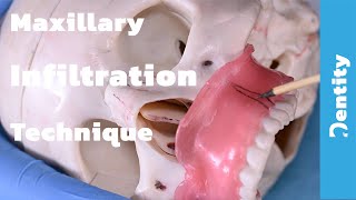 Maxillary Infiltration Technique  شرح عملي [upl. by Oswal]