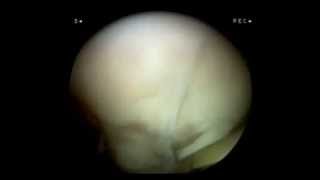 Cartilage Replacement ACI stage1 Cartilage harvest from patients knee video1 [upl. by Abbotsen816]