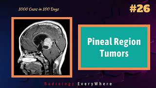 Pineal Region Tumors  Pineoblastoma  Germinoma  Pineocytoma  1000 cases in 100 days  Video 26 [upl. by Anner]