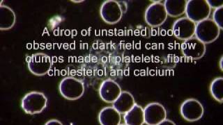 Dark Field Microscopy and Thrombosis [upl. by Stiegler501]