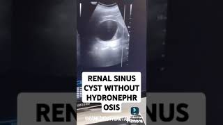 RENAL SINUS CYST WITHOUT HYDRONEPHROSIS usg radiology kidneyanatomy [upl. by Ardnuaet854]